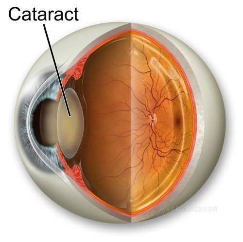 Cataract illustration