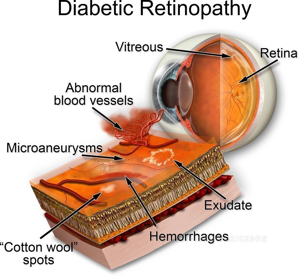 Diabetic retinopathy patient education illustration