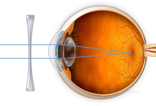 Correcting myopia with diverging lens