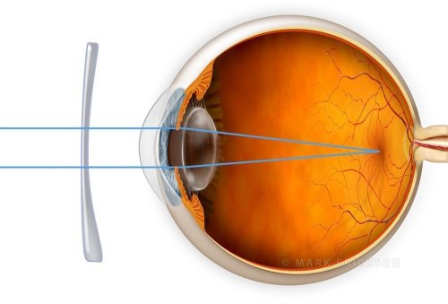 Astigmatism correction with a lens