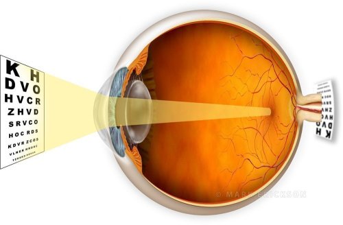 Hyperopia explanatory illustration