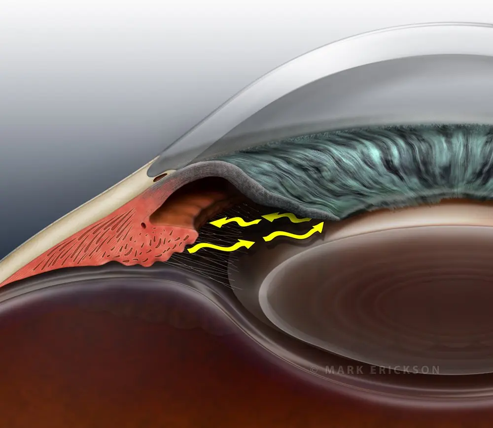 Closed angle glaucoma