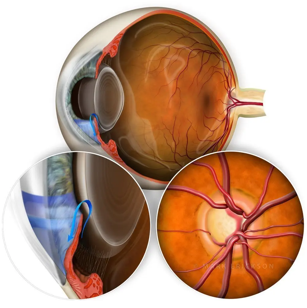 Glaucoma illustration