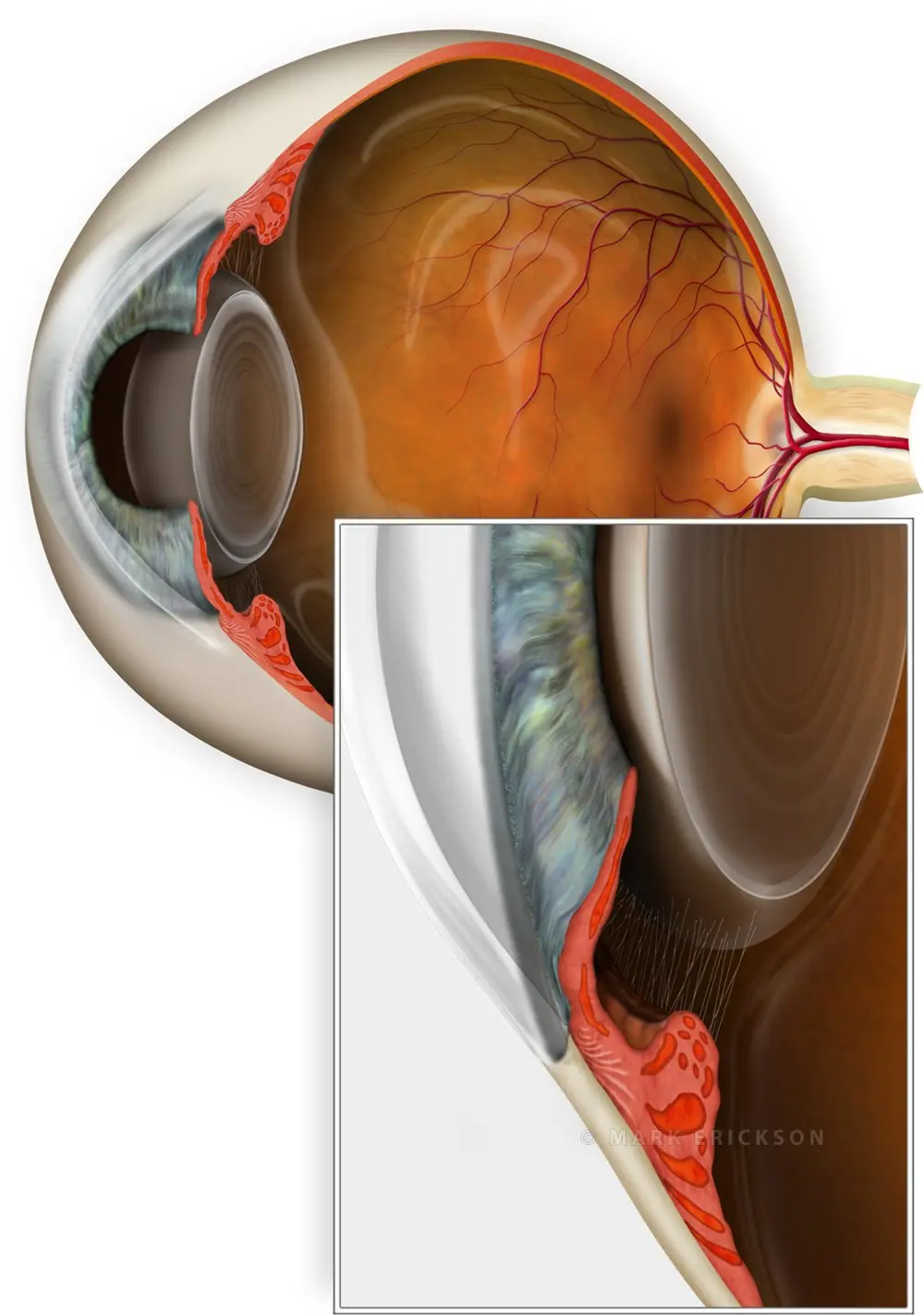 Narrow angle anterior chamber