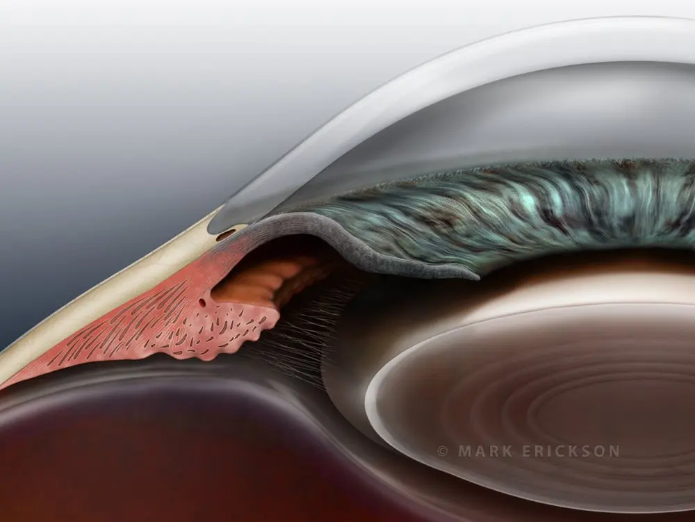 Narrow angle of the anterior chamber
