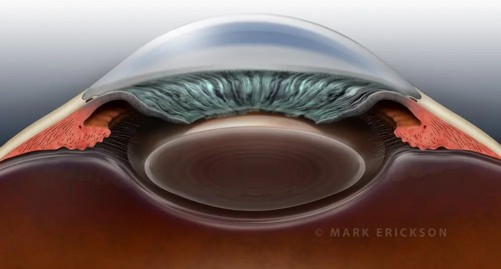 Closed angle glaucoma - co0049