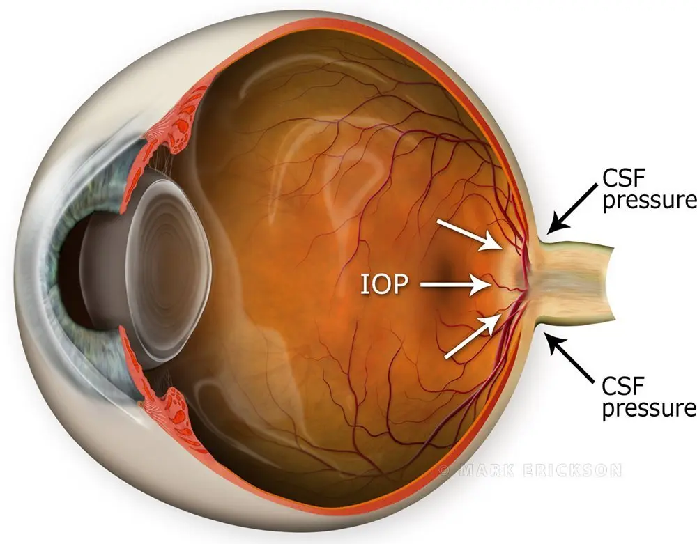 CSF fluid vs IOP intraocular pressure
