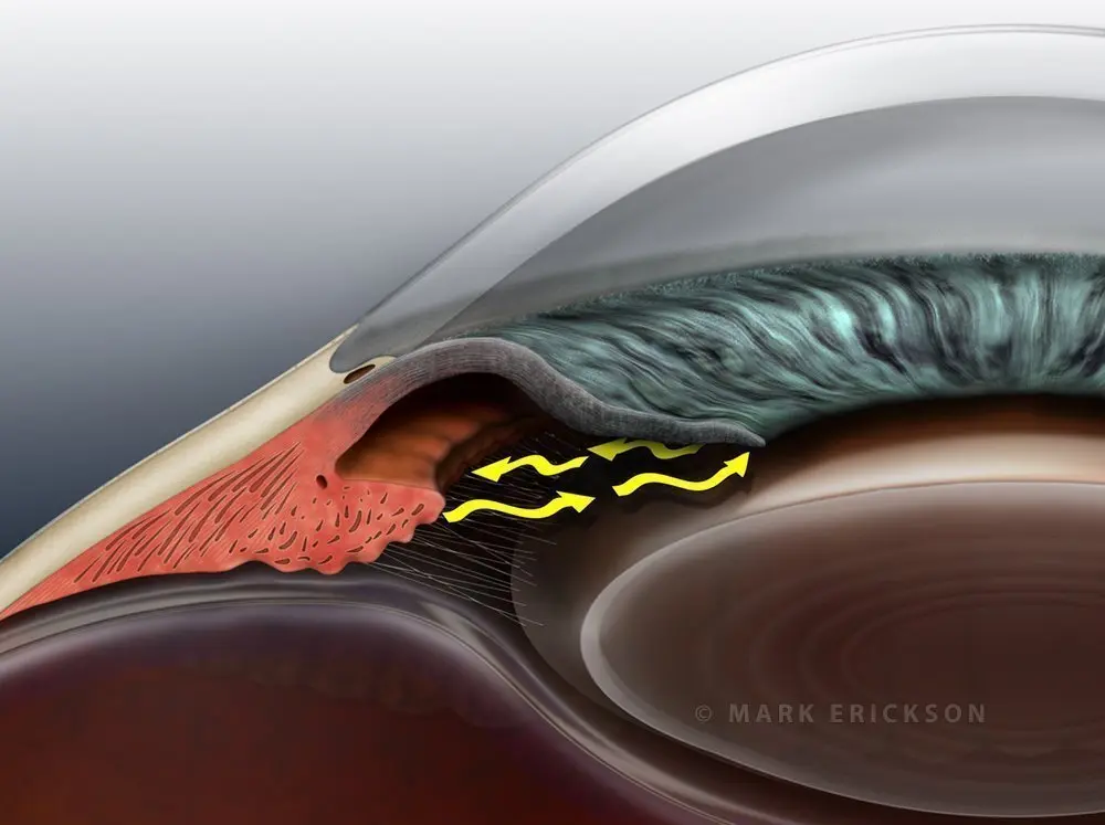 Narrow angle glaucoma