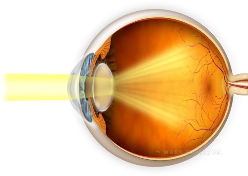 Cataract vision effects