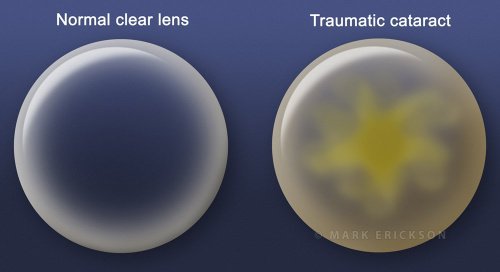 Cataract vs clear lens illustration