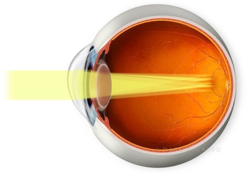 Astigmatism light rays in cross section eyeball