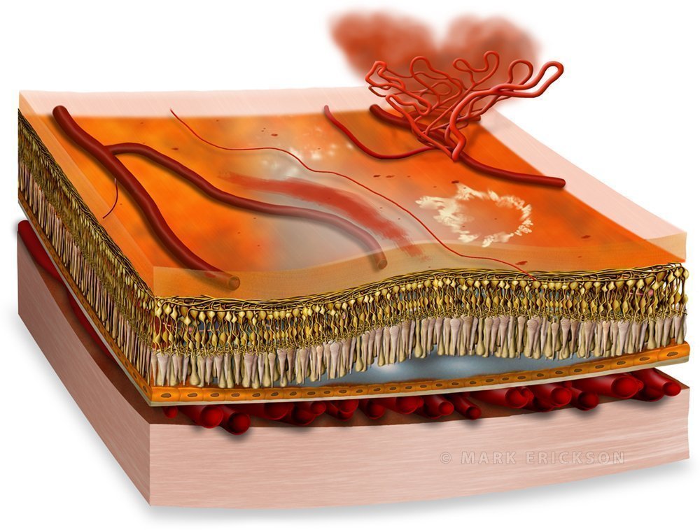Proliferative diabetic retinopathy retinal cross section