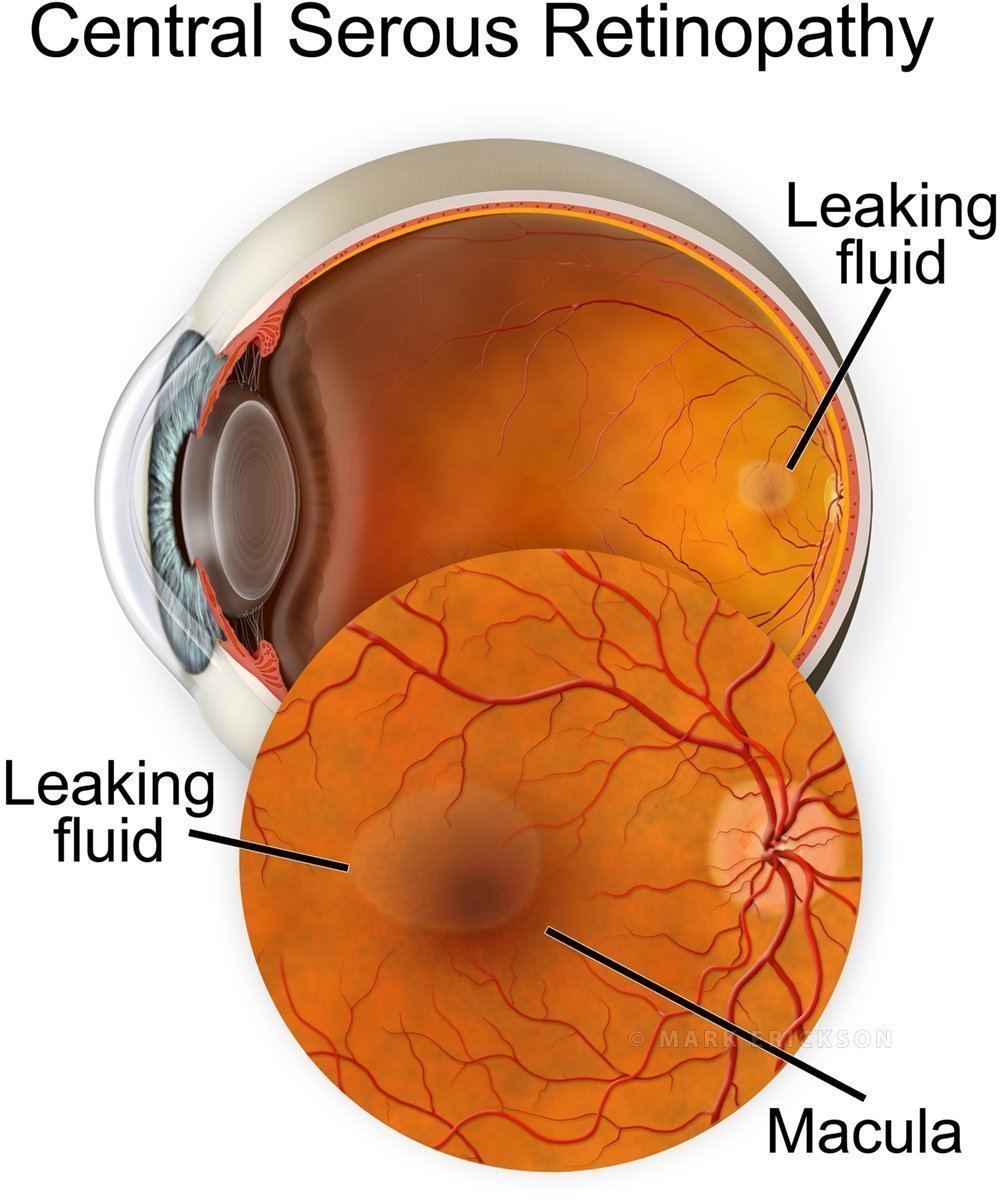 Central serous retinopathy illustration