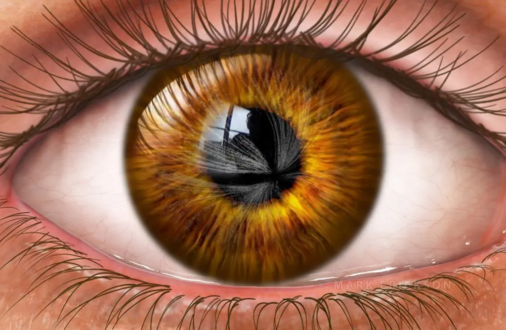 vortex keratopathy medical illustration
