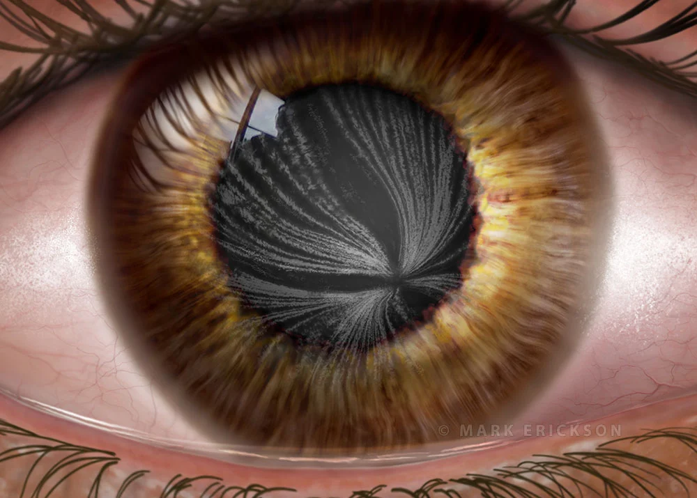 Medical illustration of corneal verticillata (corneal whorl) showing vortex keratopathy