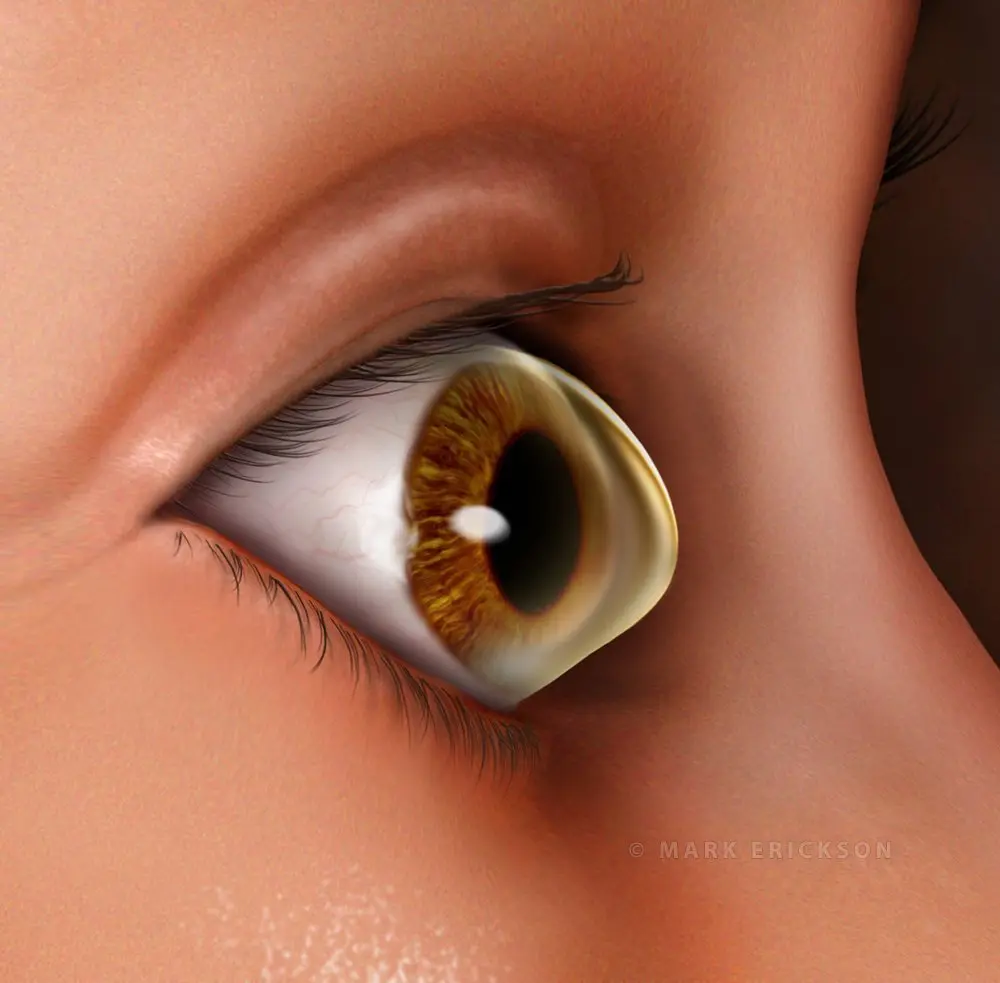 Keratoconus corneal disease illustration