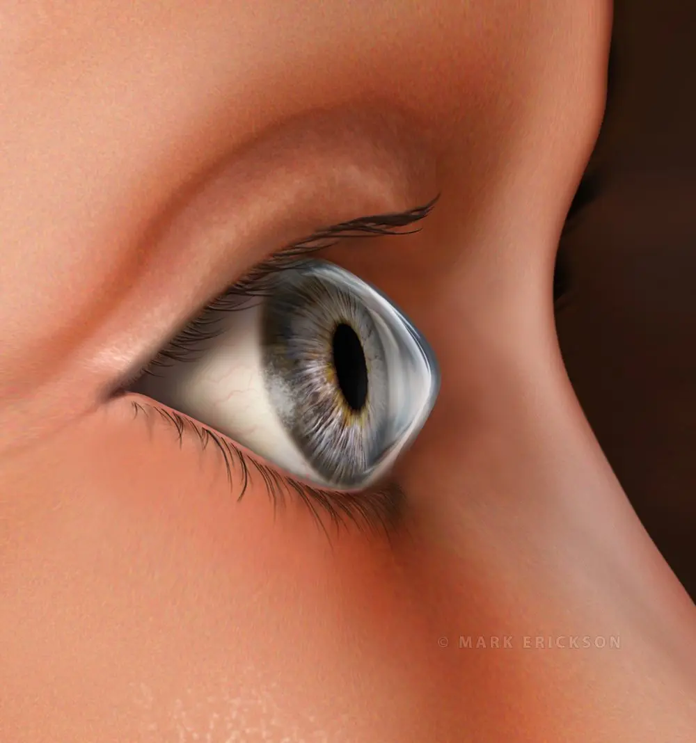 Keratoconus corneal thinning eye disease