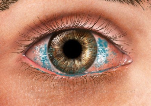 Lissamine corneal stain for dry eye syndrome