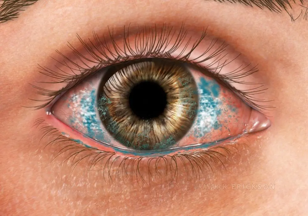 Lissamine corneal stain for dry eye syndrome