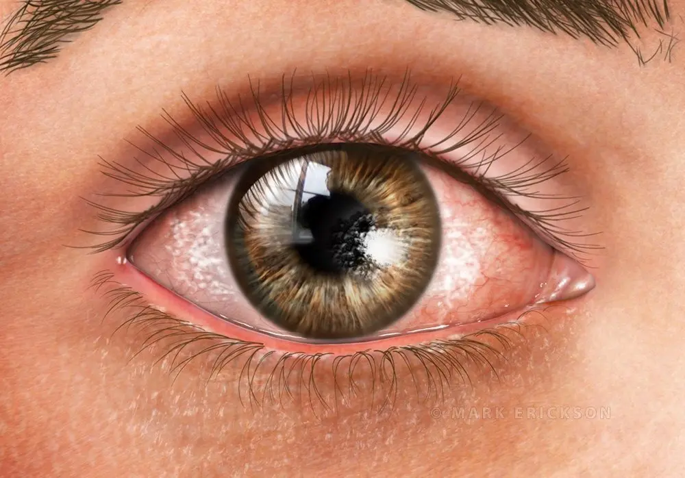 Dry eye syndrome