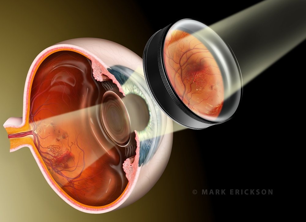 Indirect ophthalmoscopy exam on diabetic retinopathy