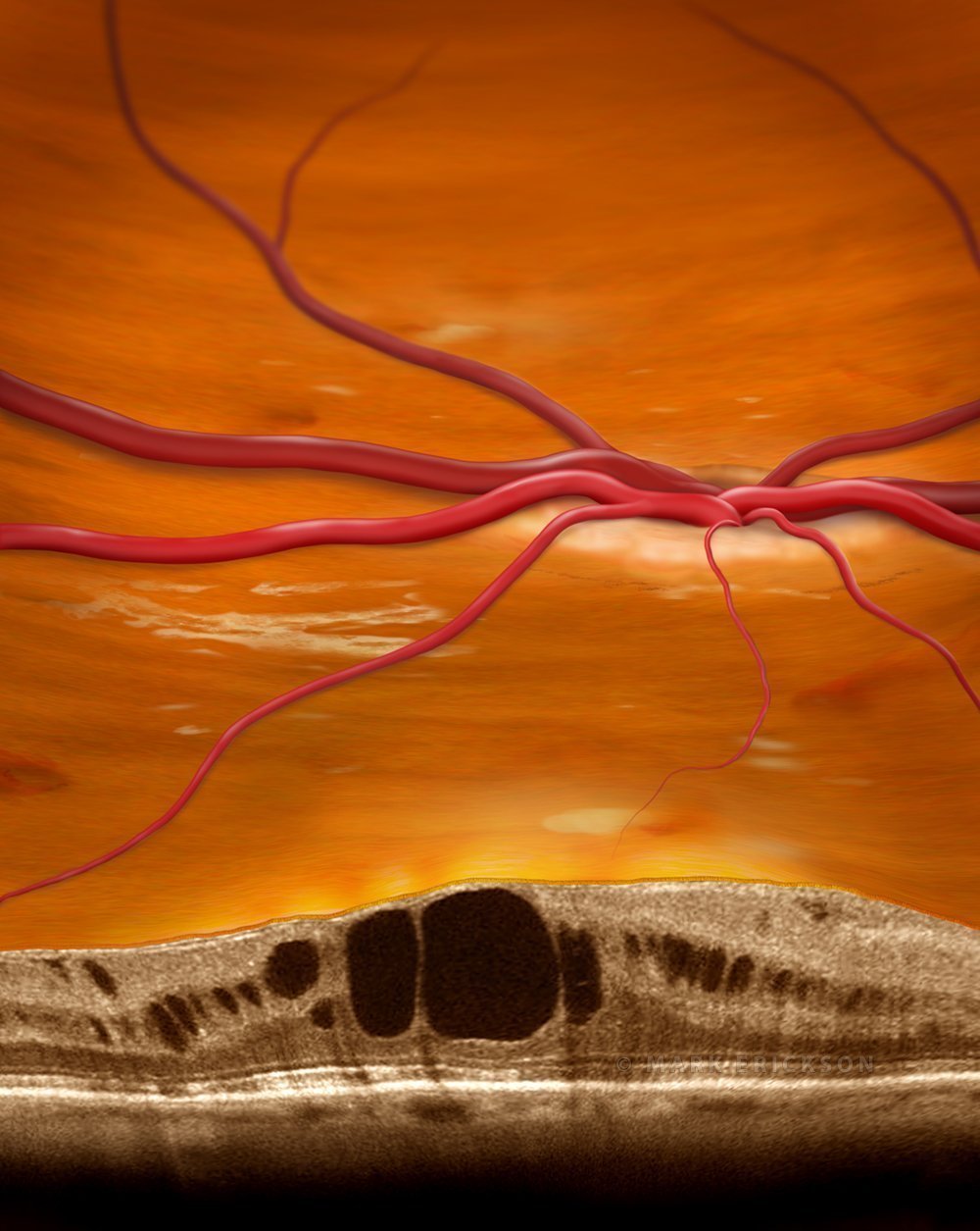 Diabetic macular edema and OCT art