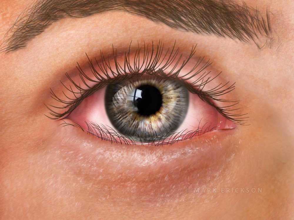 Entropion, inward turning of the eyelid