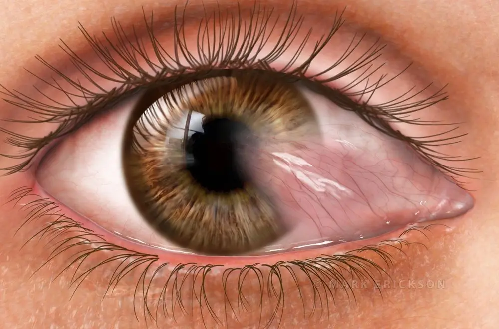 Pterygium conjunctival growth cornea