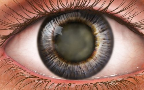 Cataract in the lens of the eye