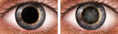 Cataract vs clear lens in the eye