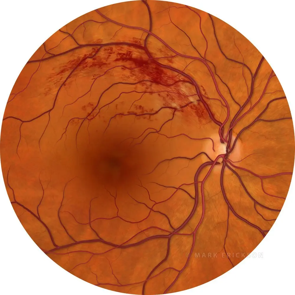 Branch retinal vein occlusion, BRVO posterior pole image DOWNLOAD brvo Branch retina vein occlusion