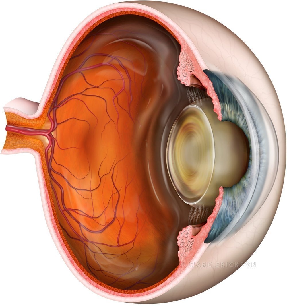 Cataract eye anatomy schematic
