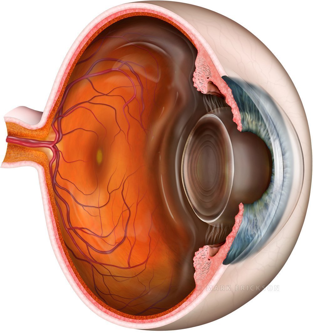 Solar retinopathy eye illustration