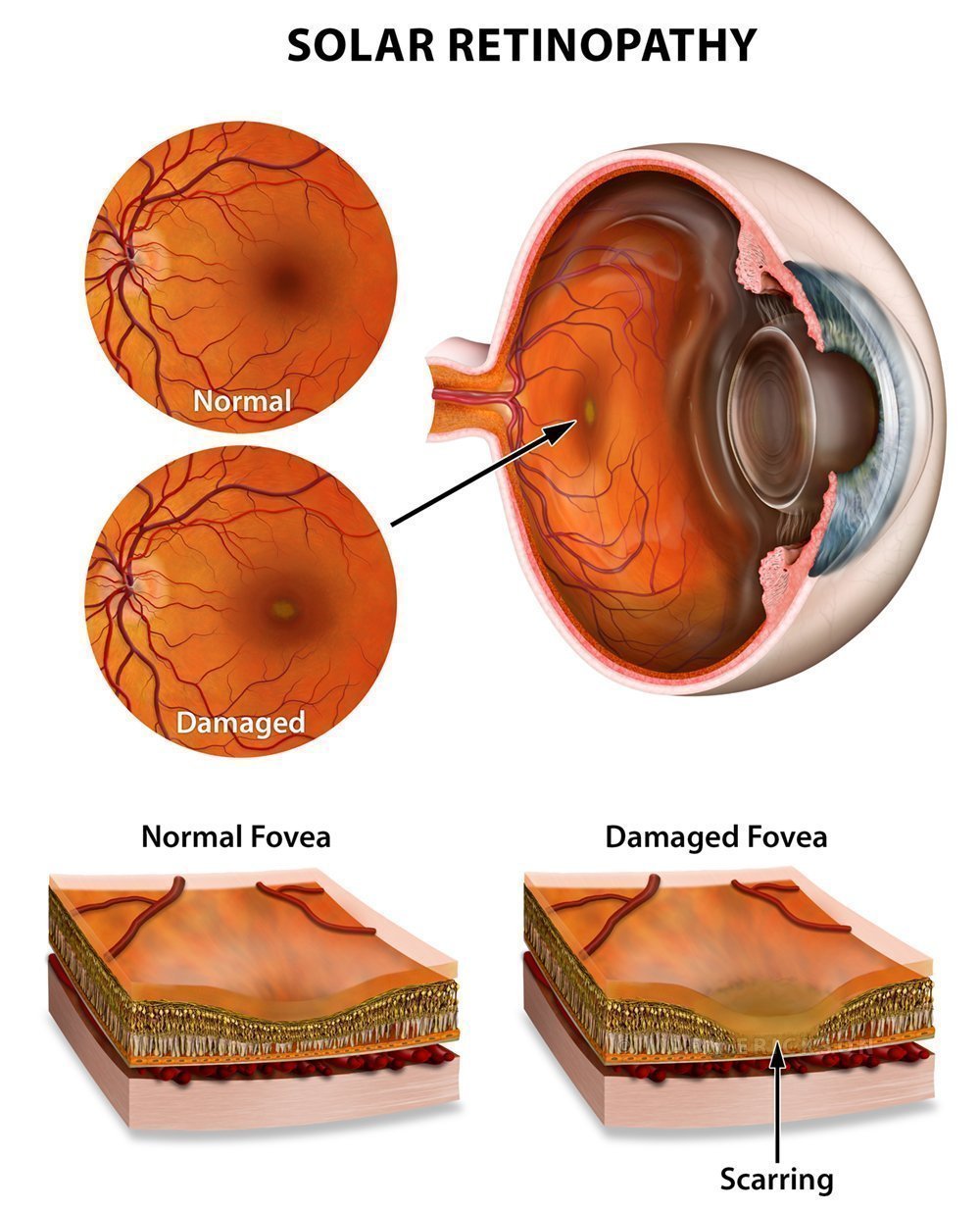 Solar retinopathy poster