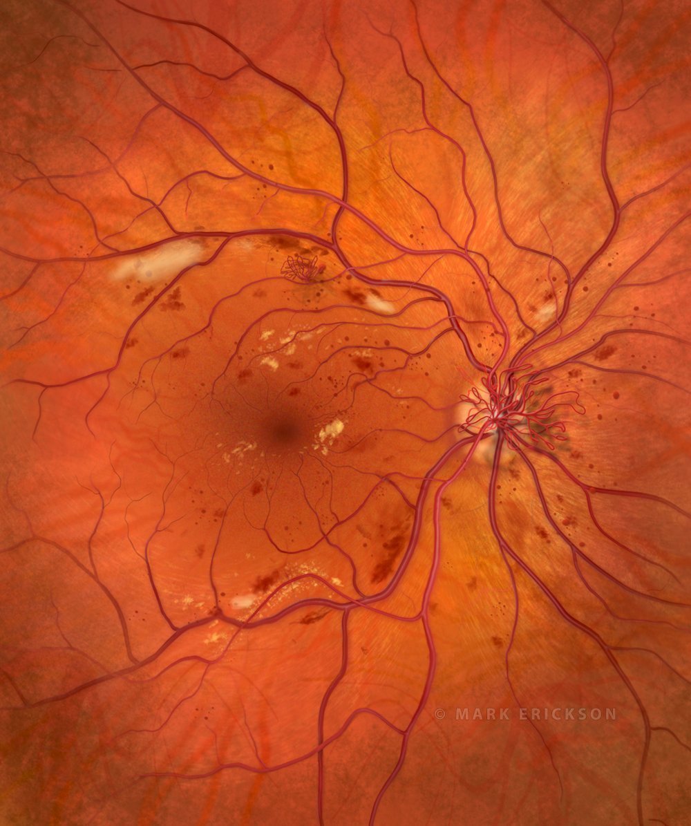 Proliferative diabetic retinopathy illustration