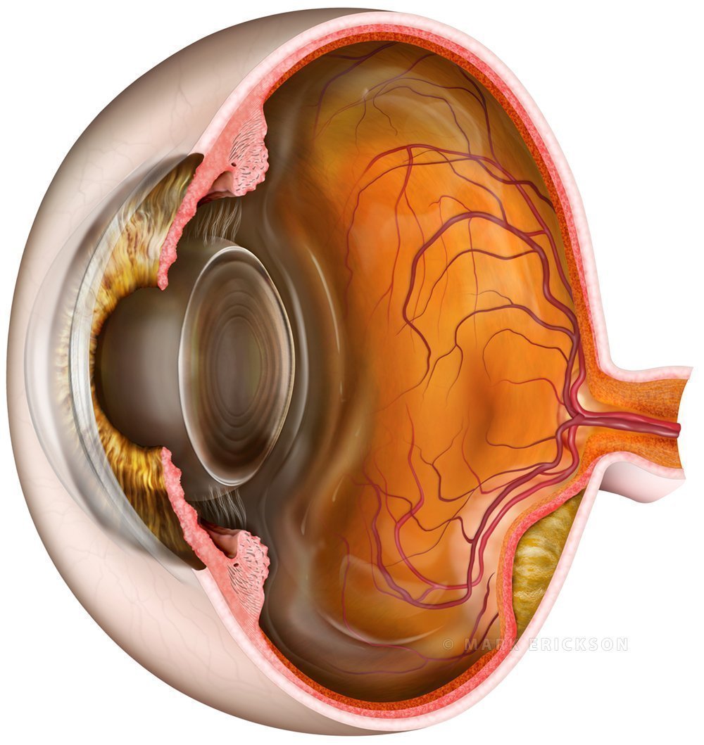 Choroidal melanoma cross section