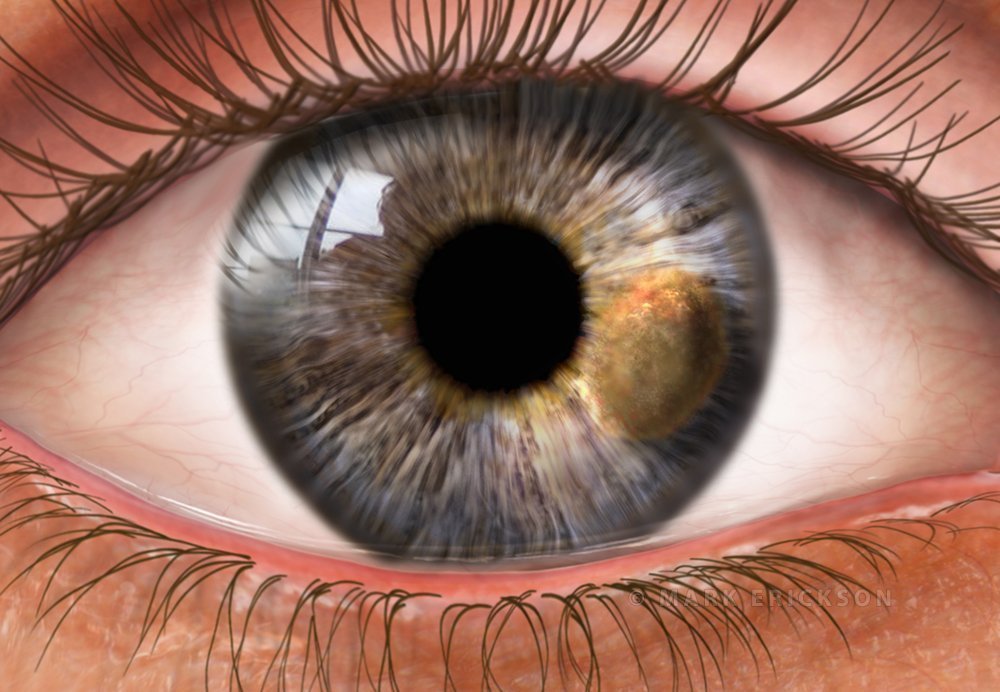 Iris melanoma illustration