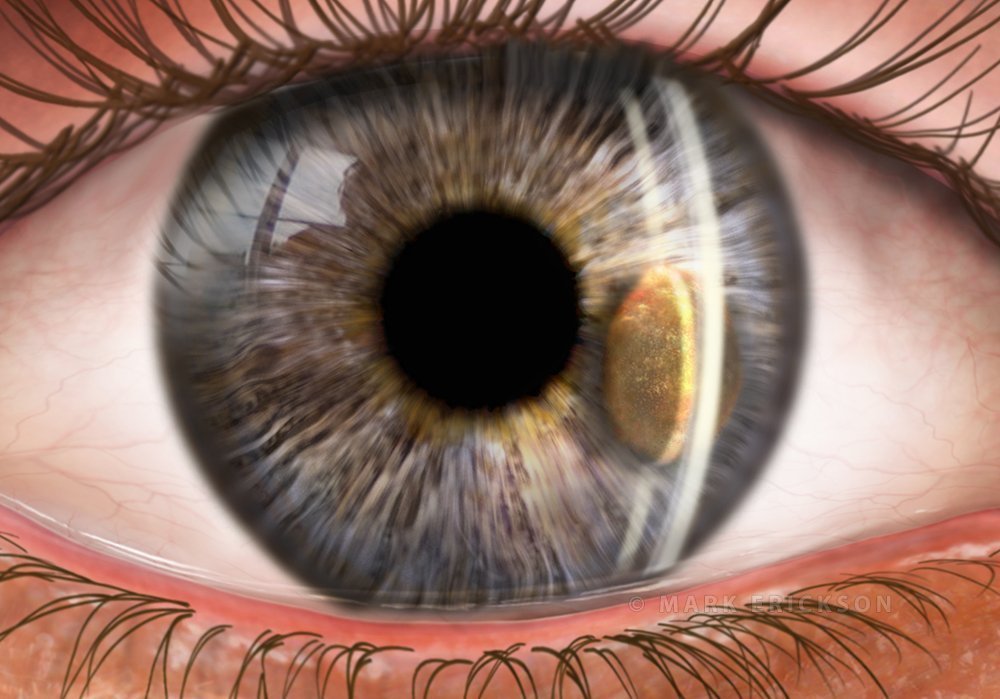 Iris melanoma slit lamp exam