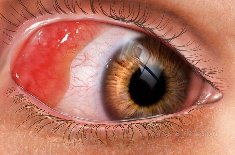 Conjunctival lymphoma medical illustration for patient education
