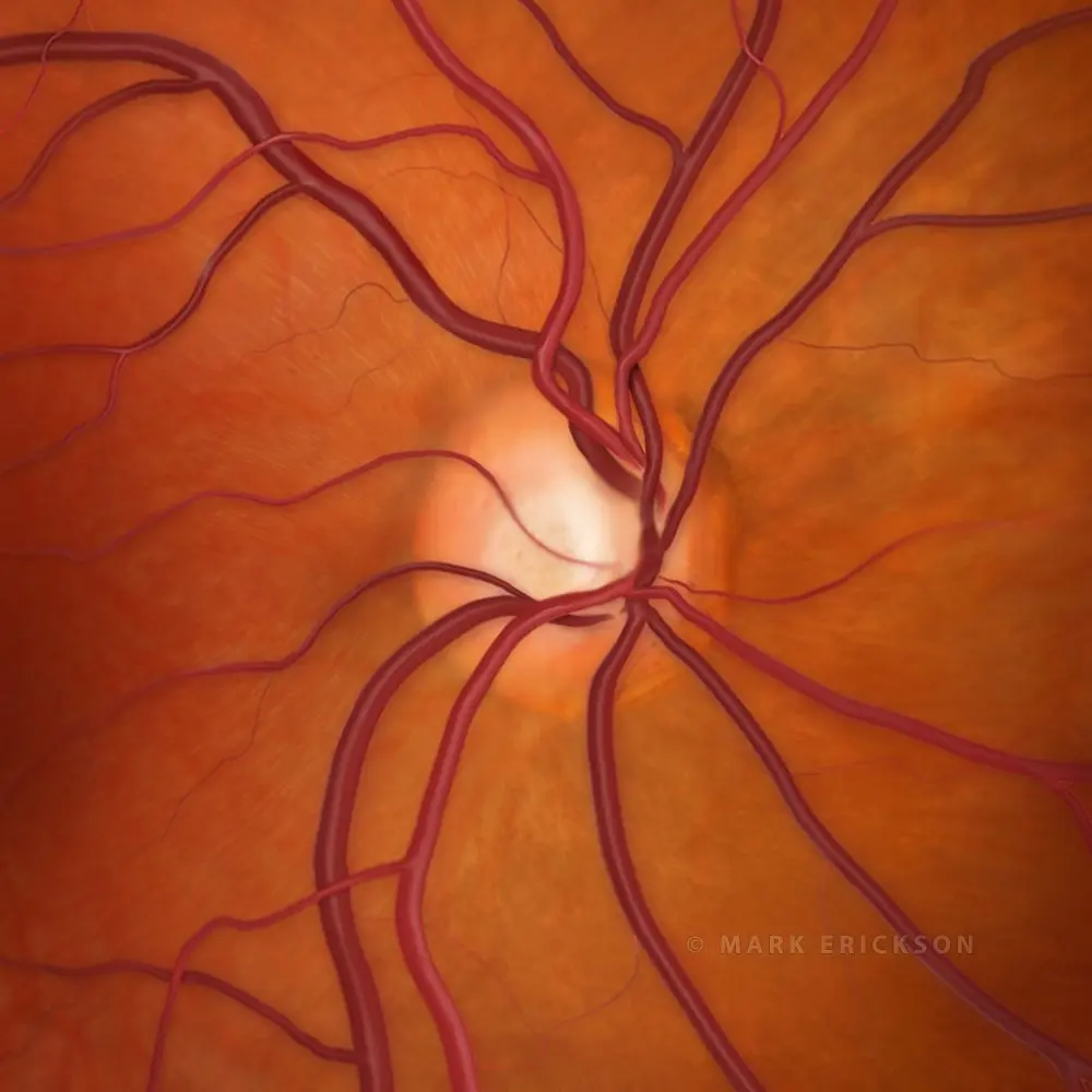 Optic nerve cupping in glaucoma