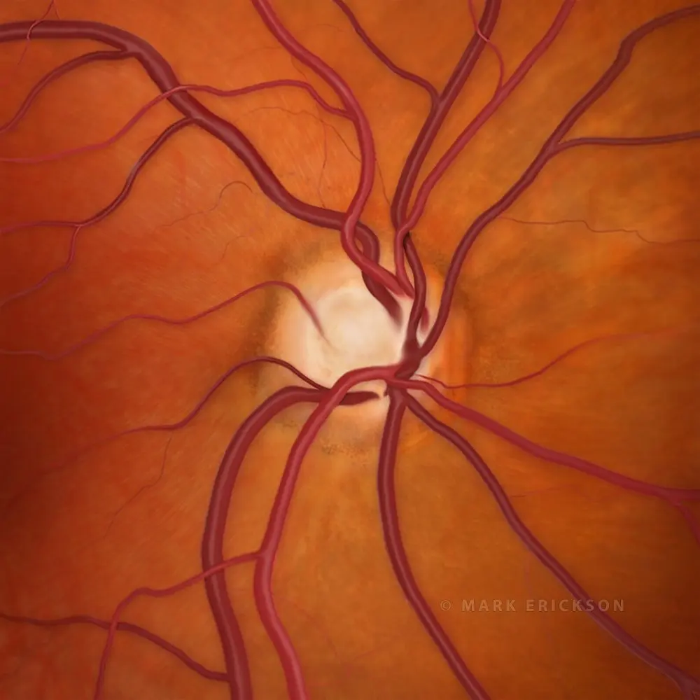Optic nerve cupping in glaucoma