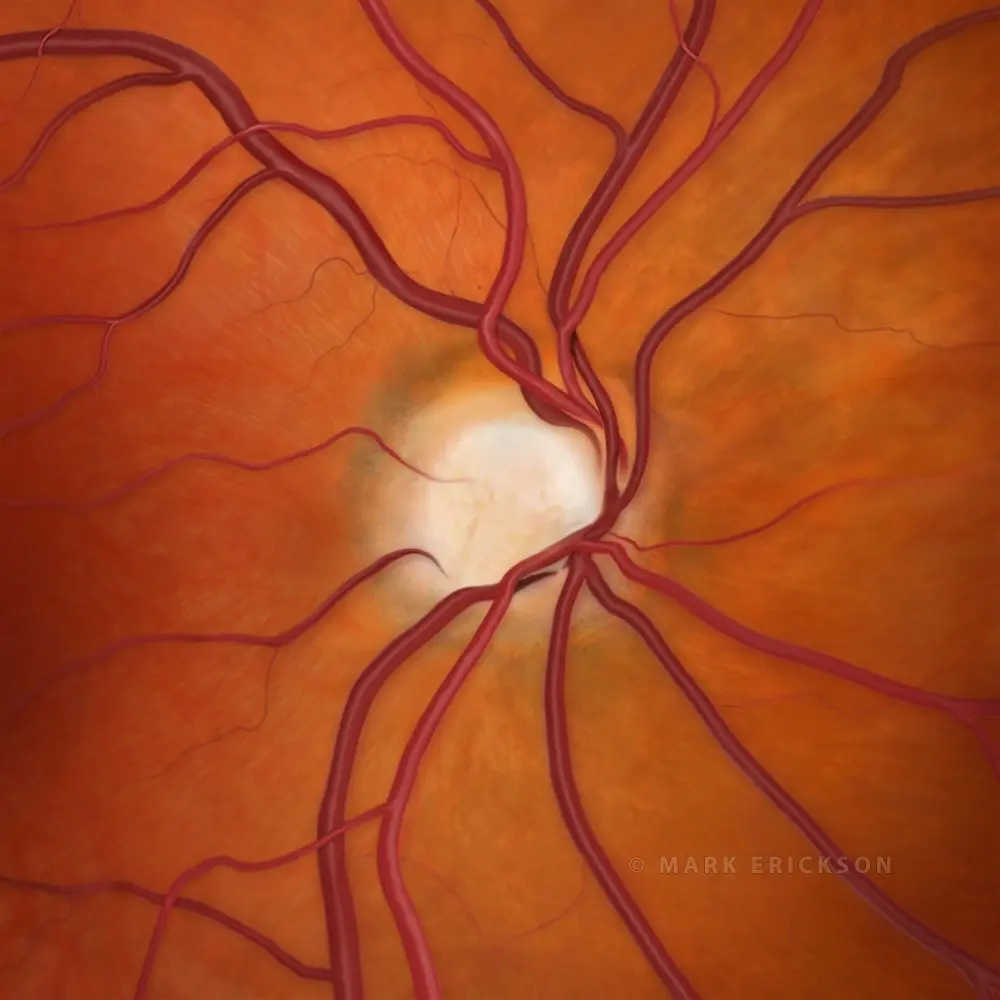 Glaucoma optic nerve cupping end stage