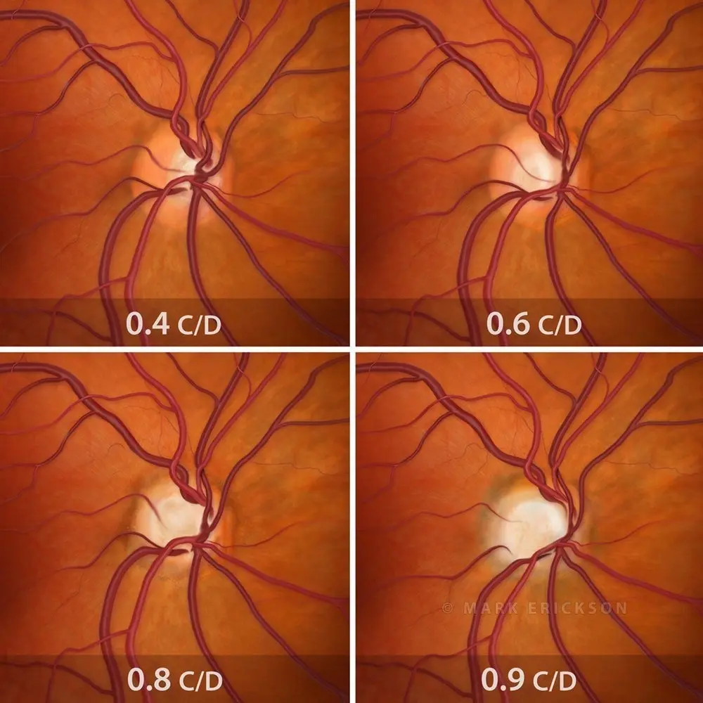 Optic nerve cupping progression in glaucoma