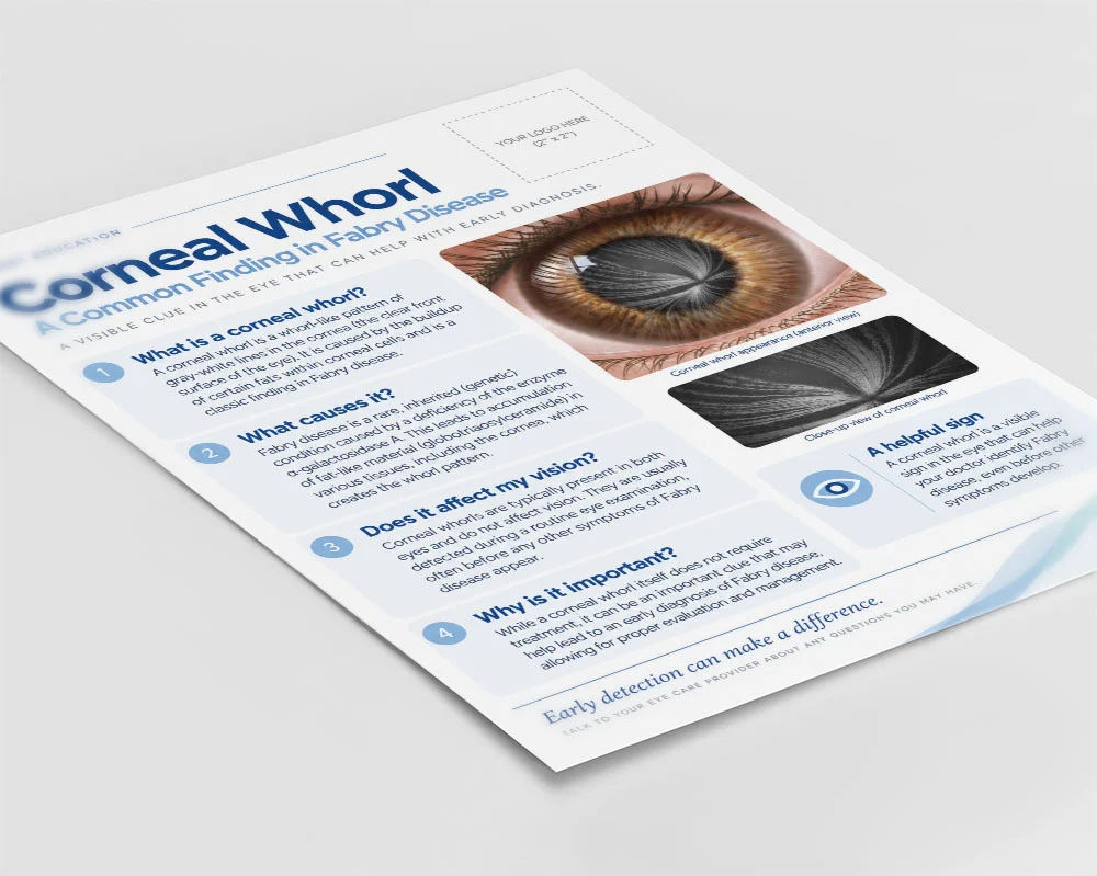 Corneal verticillata medical illustration for slide presentations cornea verticillata Cornea verticillata handout for patient education