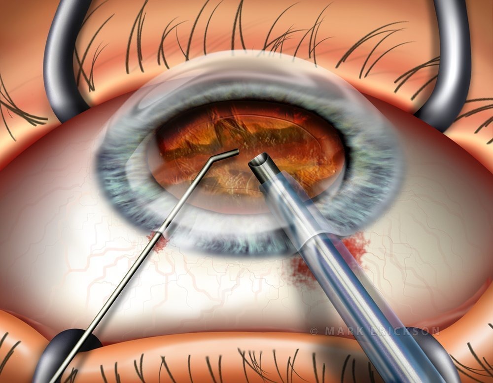 Phacoemulsification divide and conquer technique
