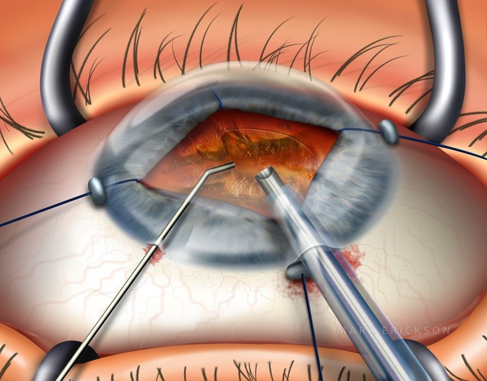 Floppy iris syndrome phacoemulsification