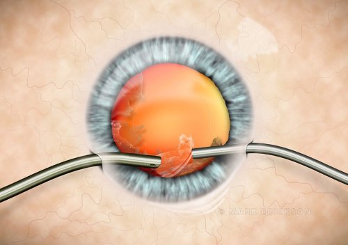 Bimanual lens cortex aspiration