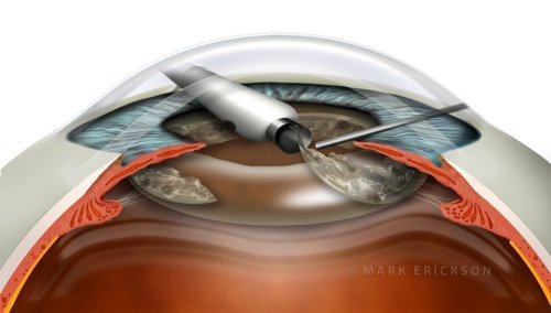 Phacoemulsification in cataract surgery, cross section illustration