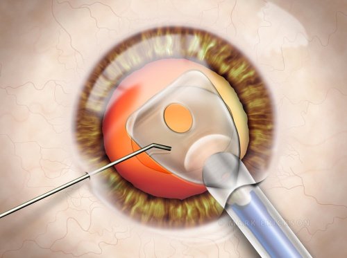 IOL insertion in cataract and iol surgery