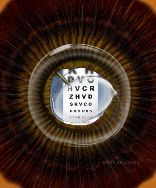 IOL implantation from an inside-the-eye perspective